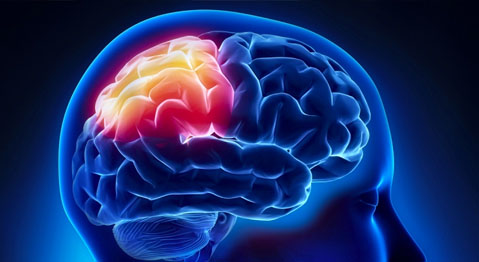 Stroke 2